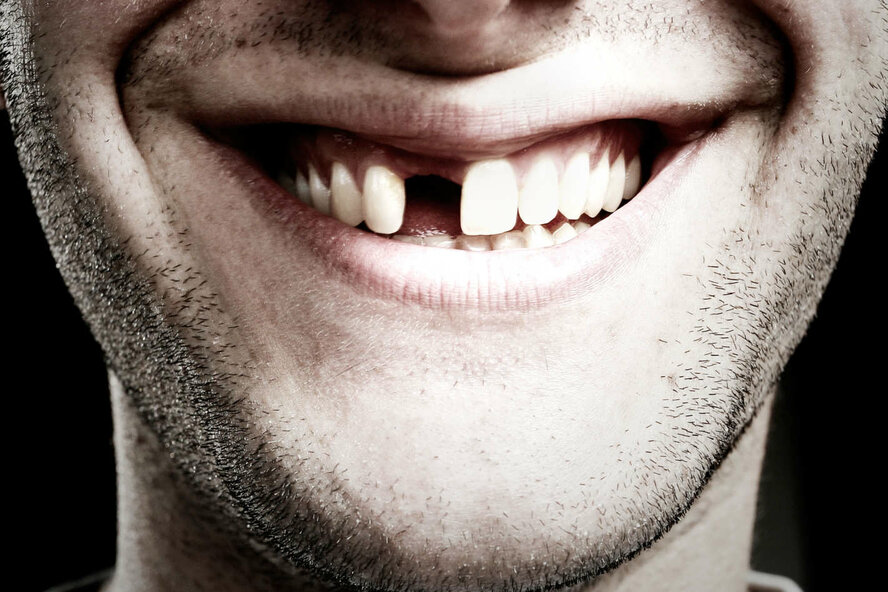 У жителей Кипра самые плохие зубы в ЕС