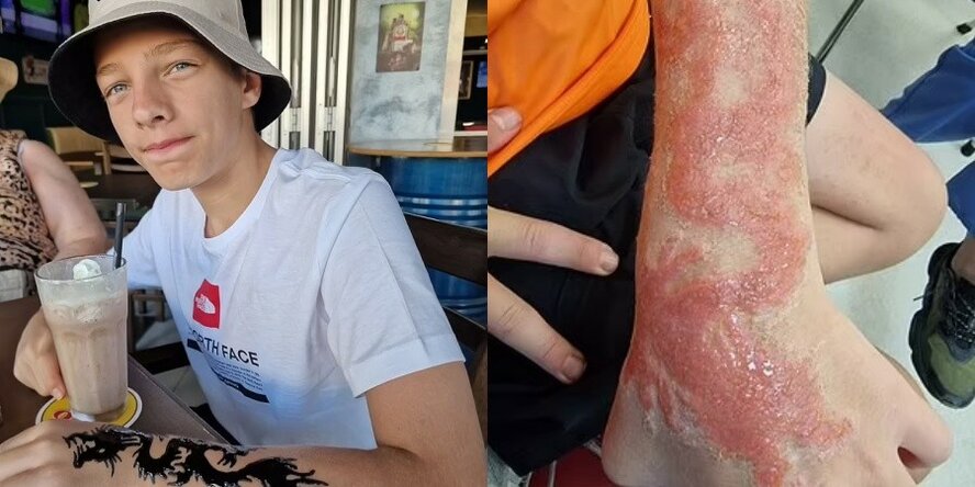 13-летний британец получил ожоги после татуировки на Кипре