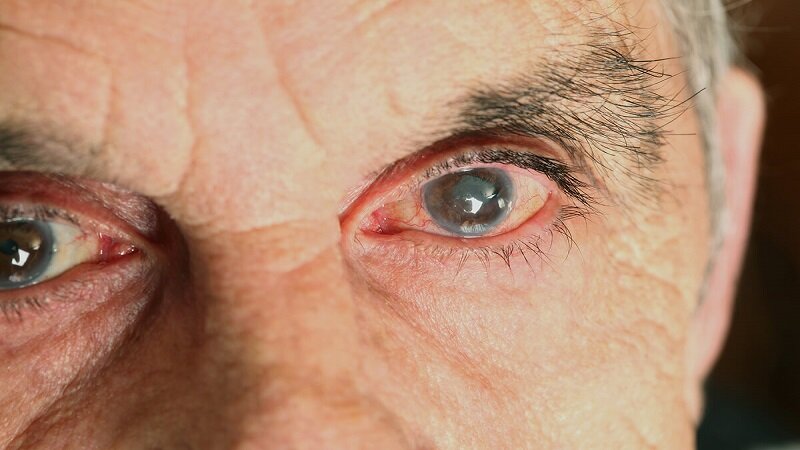 Восемь пожилых киприотов потеряли зрение после операции в частной клинике