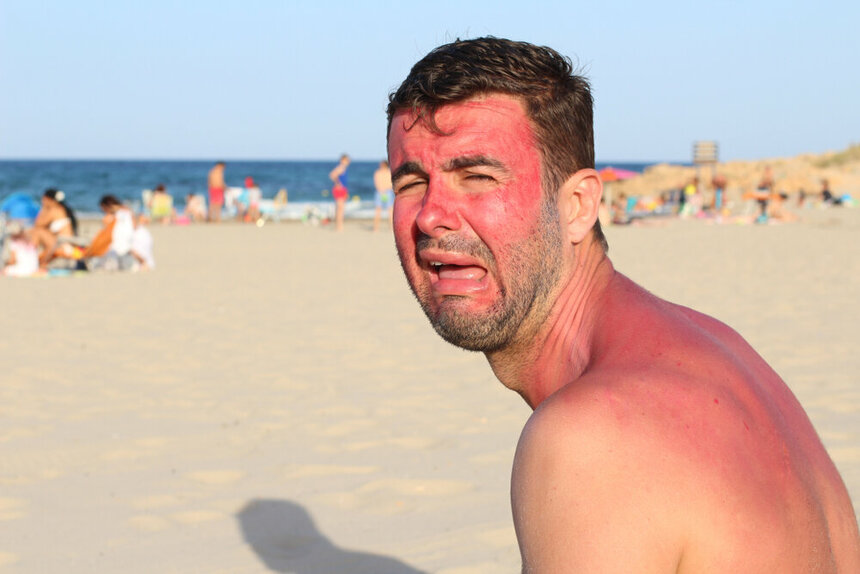 Турист обгорел на пляже.