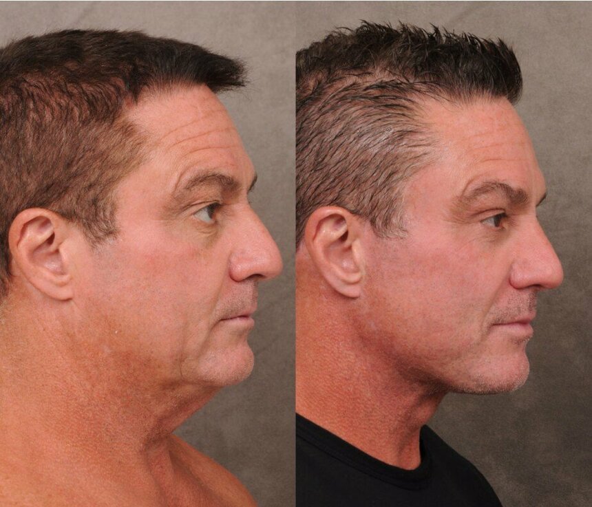 Кипрские айтишники выстраиваются в очереди на процедуру подтяжки лица : фото 2