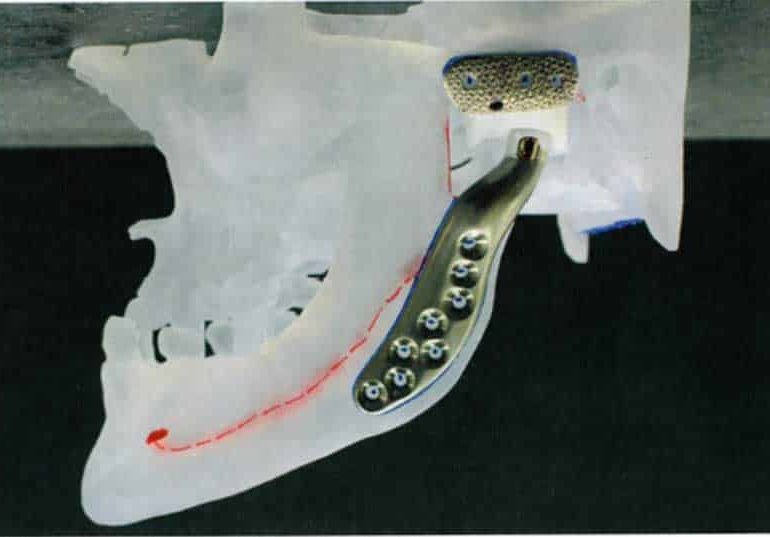 Кипрские врачи провели редкую операцию по установке имплантата в челюсти пациента: фото 2